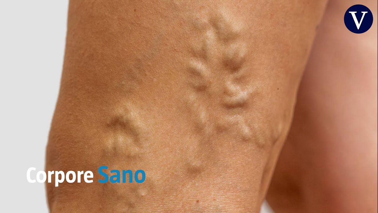 Ajo con alcohol y las varices: ¿Realmente efectivo?