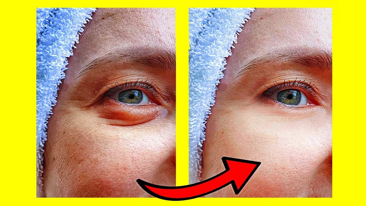 Remedios caseros para las ojeras de los niños