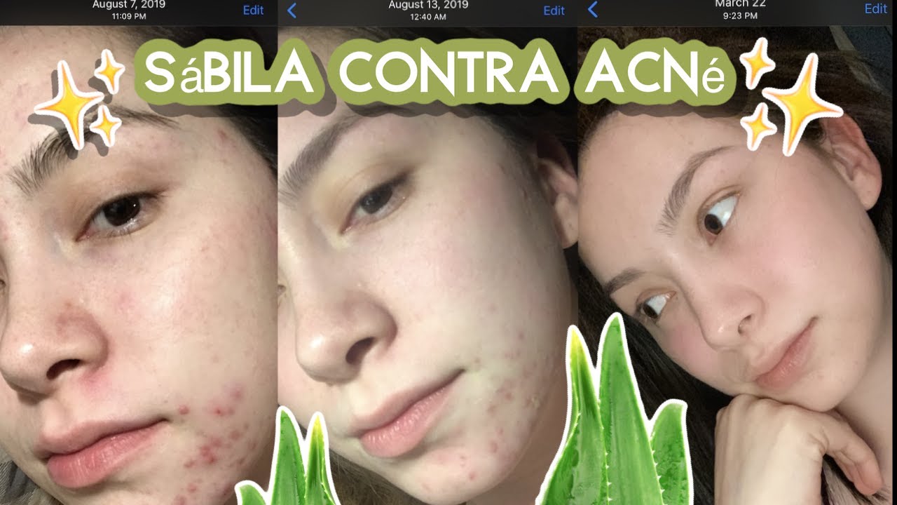Tratamiento del acné con aloe vera